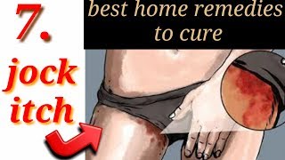 How to cure jock itch fast naturaly  7 best home treatment for jock itch by natural remediestips [upl. by Benedicta]