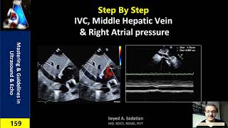 Step by Step IVC Hepatic vein amp Right atrial pressure [upl. by Sellers]