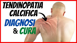 🔴 TENDINOPATIA CALCIFICA di SPALLA  Come si diagnostica e si cura [upl. by Samot391]