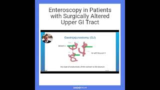 Enteroscopy in Patients with Surgically Altered Upper GI Tract [upl. by Jacobson]