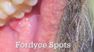 Fordyce Spots white yellow bumps over lips and cheek Should I worry [upl. by Kablesh]