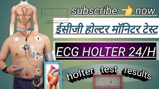 ecg holter monitor test  holter test results  holter monitor 24 hoursheart holter testviral [upl. by Violette]