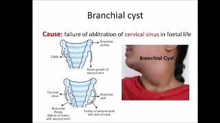 Branchial cyst [upl. by Ayekram]