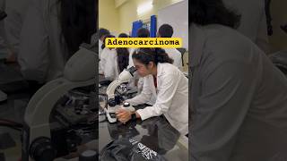 Adenocarcinoma of Gallbladder cancer breastcancer mbbs mbbsstudentlife mbbsadmission2024 [upl. by Oimetra952]