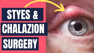 Surgery for Styes and Chalazions and Eyelid Bumps [upl. by Anaek]