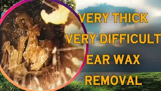 Very thick ear wax removal Very difficult to removed [upl. by Hodess]