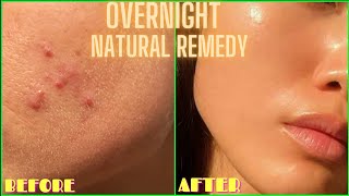 HOW TO GET RID OF ACNE PIMPLES BUMPS ON FACE OVERNIGHT  Simple Home Remedy DIY Lemon Treatment [upl. by Ynaoj]