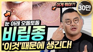 눈밑에 비립종 왜 생길까 피부과의사가 알려주는 비립종 똑 없애는 예방법 4가지 깨끗한 눈가만들기 [upl. by Auof]