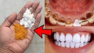 Magic Teeth Whitening  Remove Plaque and Tartar Fast 🧙‍♂️✨ [upl. by Akirdnahs]