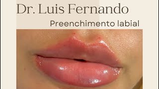 PREENCHIMENTO LABIAL [upl. by Topliffe147]