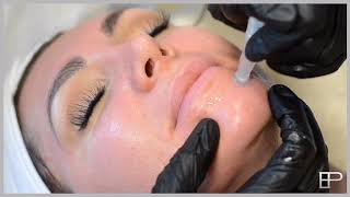 Meso Skin Rejuvenation Video skin needling [upl. by Yssis]