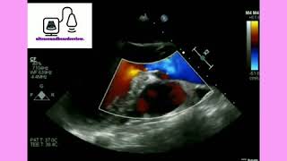 Echocardiography [upl. by Aicsila]