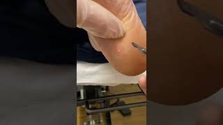 Expert Australian Podiatrist Removes Painful Corns with Precision [upl. by Oderfla]