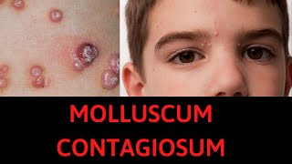 What is Molluscum Contagiosum Symptoms Treatment [upl. by Pilif690]