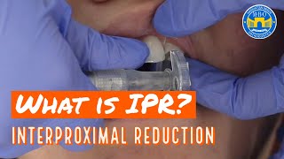 Interproximal Reduction IPR on Teeth for Braces and Invisalign [upl. by Aihtiekal806]