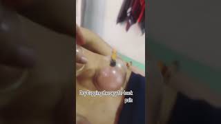 Cupping therapy for back painneurotherapy [upl. by Merkle]