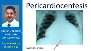 Pericardiocentesis [upl. by Retla915]