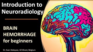 Imaging of Spontaneous Brain Hemorrhage the basics [upl. by Lleval]