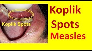 Koplik Spots in Measles [upl. by Onaivlis287]