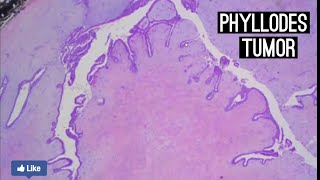 Phyllodes Tumor [upl. by Arramat]