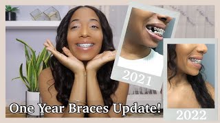 1 YEAR WITH BRACES UPDATE  Closing Gaps Elastics Power Chains [upl. by Aimet]