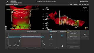 Exactrac Dynamic Breath Hold CBCT Workflow [upl. by Vaughan]