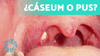 Cómo DIFERENCIAR el CÁSEUM de la PUS 👄 ¿Cómo prevenir el cáseum [upl. by Aruol]