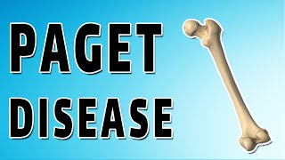 Pagets Disease [upl. by Enrica452]