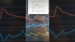 JVP waveform [upl. by Ahsienal]