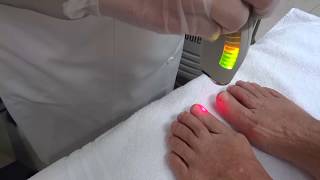 Micose de Unha  Tratamento com laser [upl. by Selwyn]