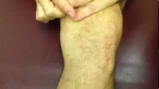 bulge sign for knee effusion [upl. by Mike384]