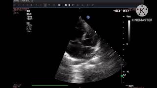 Sinus Venosus ASD of IVC type ￼ [upl. by Esinert]