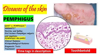 Pemphigus Vulgaris Pathogenesis clinical features oral manifestations  Pemphigus Variants PART 1 [upl. by Anit]