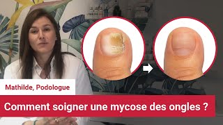 Soigner et reconnaitre la mycose des ongles des pieds  Conseil dune podologue [upl. by Aivital]