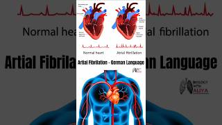 Artial Fibrilation  German Language medical animation 3d short [upl. by Eleaffar]