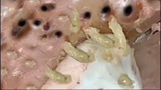 Pimple Popping 2020 Video 40 Blackheads removal Acne removal acne treatment [upl. by Acceber287]