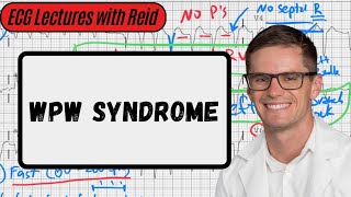 WolffParkinsonWhite Syndrome  Day 17 ECG Challenge [upl. by Isdnil]