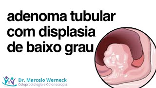 Adenoma tubular com displasia de baixo grau O que é isso [upl. by Gannie]