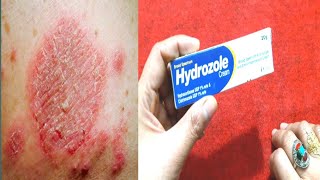 Hydrozole Cream Benefits And Uses Stop Skin itching Fungl  Khooni Kharish By Sanam [upl. by Lammaj742]