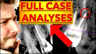 Advanced Dental Radiographs Interpretation CARIES amp Radiolucent LESIONS  OPG Xray 3D CBCT reading [upl. by Dominus]