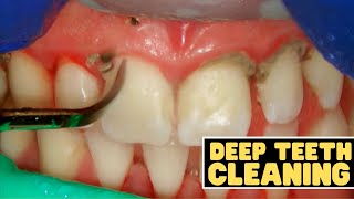 Teeth Cleaning vs Deep Cleaning  Dentist Reviews How Teeth Are Cleaned [upl. by Ful]