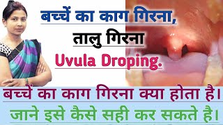 बच्चे का काग गिरना  तालु गिरना क्या होता है व कैसे सही करे। Uvula Droping [upl. by Renato253]