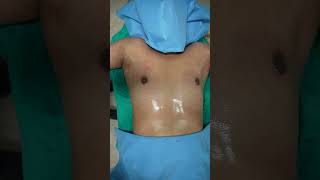 Gynecomastia cure  Gynecomastia Surgery immediate result shorts [upl. by Myrah]