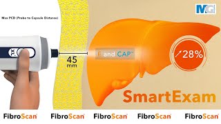 MediGroup I SmartExam  Continuous CAP™  Nâng cao giá trị của FibroScan® [upl. by Adaynek]