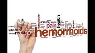 Hémorroïdes  Symptômes diagnostic et options de traitement  Emborrhoid  un remède sans douleur [upl. by Serafina]