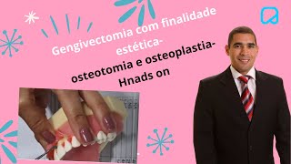 Gengivectomia com finalidade estética osteotomia e osteoplastiaHnads on dralexguedes [upl. by Eiba]