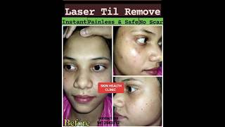 Laser til removal skincare lasertattoo facecleanup shorts viralvideo pigmentation [upl. by Nale251]