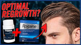 Combining Finasteride amp Minoxidil [upl. by Reilamag556]