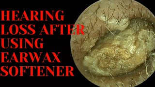 Hearing LOSS After Using Earwax Softener [upl. by Gabriele294]