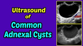 Ultrasound of Common Adnexal Cysts [upl. by Adieren]